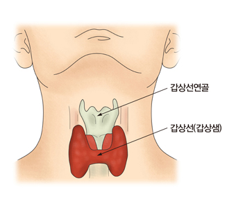 갑상선염