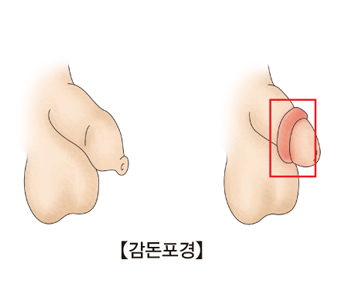 감돈포경