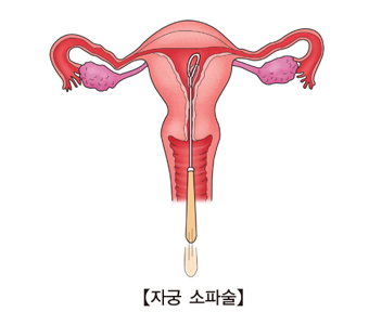 융모막 암종