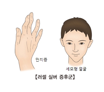 러셀 실버 증후군