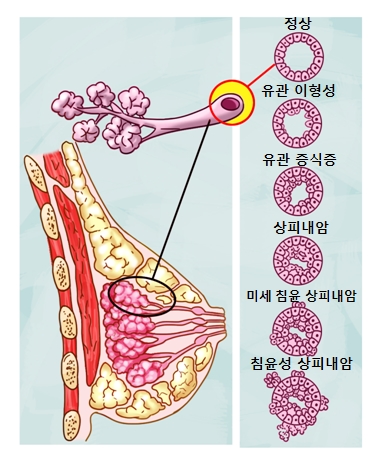 유방 상피내암