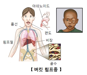 버킷 림프종