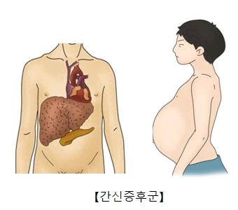 간신증후군