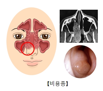 비용종