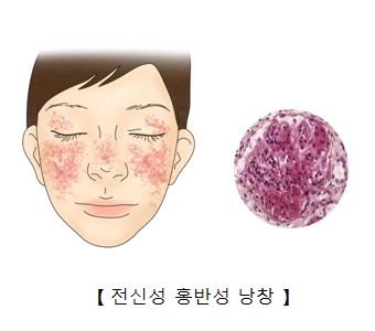 전신 홍반성 낭창