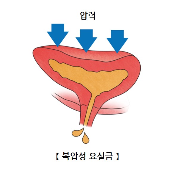 스트레스성 요실금