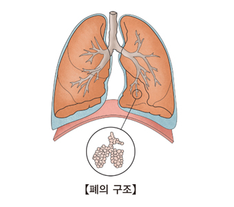 소세포성 폐암