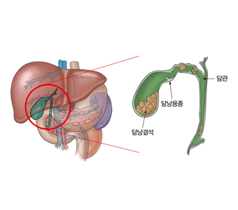 담낭 결석