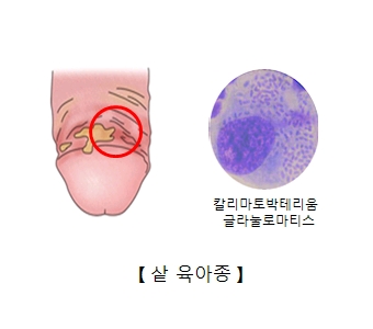 샅(서혜)육아종