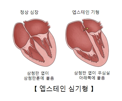 엡스테인 심기형