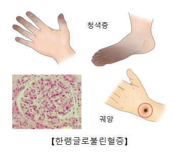 한랭글로불린혈증