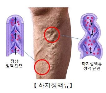 하지정맥류