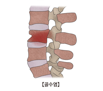 척수골수염