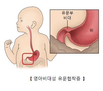 영아 비대성 유문협착증