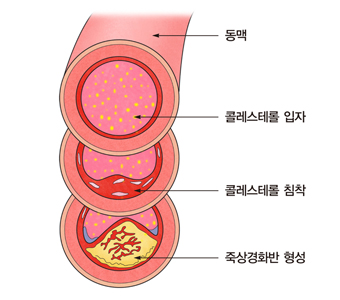 고콜레스테롤혈증