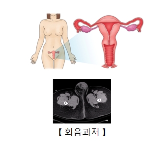 회음괴저