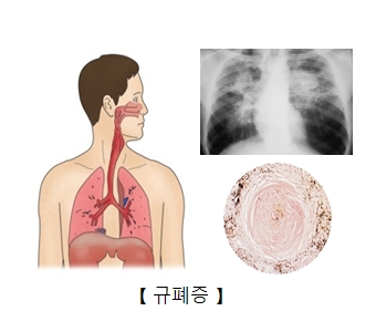 규폐증