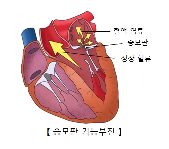 승모판 기능부전